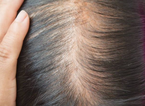 Why is your Hair Thinning & 12 Treatable Ways to Stop it
